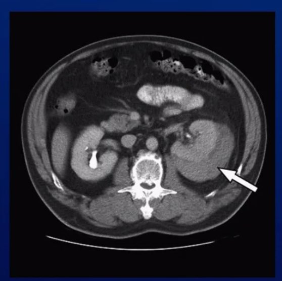 MayoUrology's tweet photo. Today’s #MondayMorningConference question. Which of the following is not a risk factor for this complication after ESWL? @UroResidency @Uro_Re Question in next thread. https://t.co/unI1ymhRs1