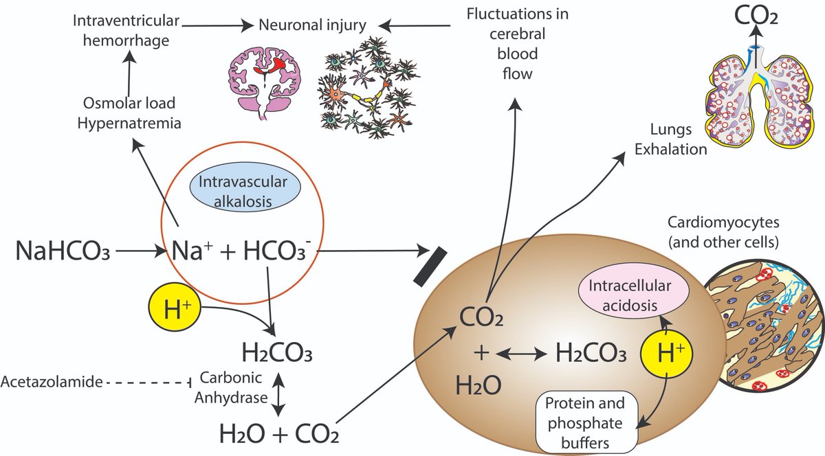 Satyan (@neosatyan) on Twitter photo Metabolic acidosis is common in preterm infants. Do you correct it? Acetate in TPN, sodium bicarbonate or no correction? Does this impact outcome? Open access <a href="/JPerinatology/">Journal of Perinatology</a> - rdcu.be/d2gXV - need for high-quality RCTs such as <a href="/BASEtrial/">BASE Trial</a> to guide evidence-based practice Metabolic acidosis is common in preterm infants. Do you correct it? Acetate in TPN, sodium bicarbonate or no correction? Does this impact outcome? Open access <a href="/JPerinatology/">Journal of Perinatology</a> - rdcu.be/d2gXV - need for high-quality RCTs such as <a href="/BASEtrial/">BASE Trial</a> to guide evidence-based practice
