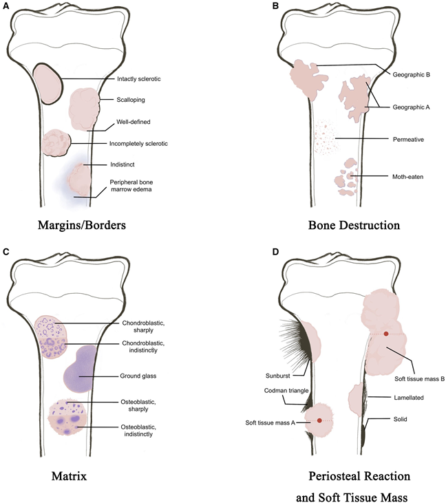 BJR_Radiology's tweet photo. Research Article
Implementation of a new classification and stratification system for solitary bone tumour: osseous tumour radiological and interpretation and management system
https://t.co/vleVJ8lhvV
#Radiology https://t.co/s8FE0cj63U