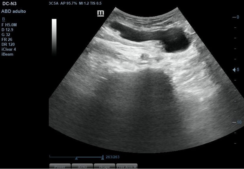 #RevistaSEMERGEN 📙Quiste de Nuck: un caso clínico en atención primaria
The cyst of the canal of Nuck: A case report in primary care
sciencedirect.com/science/articl… por <a href="/Nereasvar/">Nsanc</a> Miguel Vidal-López y <a href="/DocMPortela/">Manuel Portela Romero</a> Publicado en Revista Medicina de Familia SEMERGEN
#Ecografía