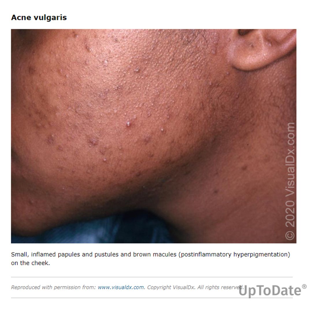 The answer to yesterday’s #ClinicalChallenge question is: True. View the related What's New topic in #UpToDate: ow.ly/WPOV50Ufqvy #dermatology #MedTwitter