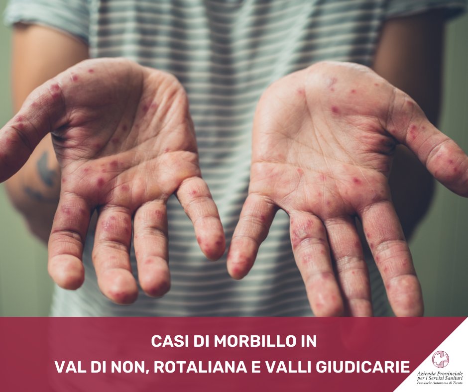 Nei giorni scorsi, quattro persone adulte sono state colpite dal morbillo. 

Per saperne di più: shorturl.at/dWTae