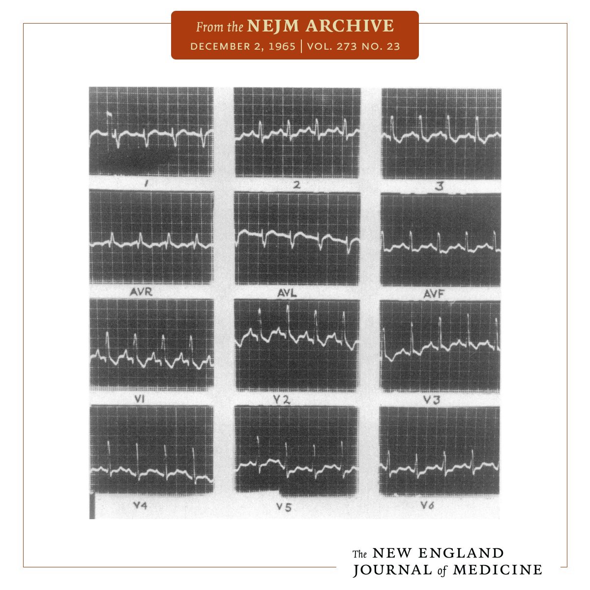 Robert Herman, MD (@roberthermanmd) on Twitter photo Just imagine not being constrained by the availability of digital ECG data to develop, validate and distribute powerful AI algorithms that go beyond human interpretation!
Here is the <a href="/PMcardioApp/">PMcardio App</a> interpretation of LV function from this ECG recorded in 1965! Just imagine not being constrained by the availability of digital ECG data to develop, validate and distribute powerful AI algorithms that go beyond human interpretation!
Here is the <a href="/PMcardioApp/">PMcardio App</a> interpretation of LV function from this ECG recorded in 1965!
