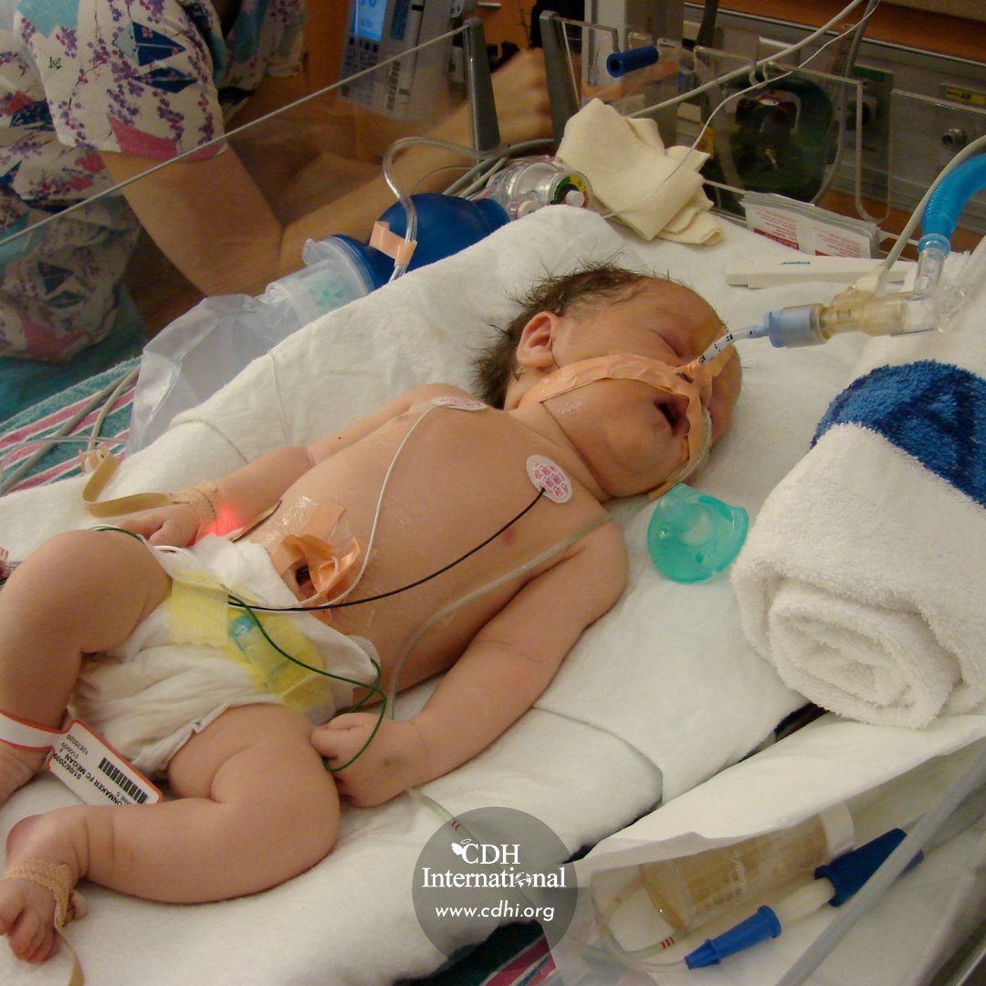 Barbara's GivingTuesday Fundraiser for CDHi in Honor of Granddaughter Harleigh

Read more at cdhi.org/barbaras-givin…

Donate at facebook.com/donate/1604947…

#cdh #cdhawareness #cdhi #cdhintl #cdhresearch #cdhsupport #patientadvocacy #cdhfeaturedfundraiser #cdhfundraiser