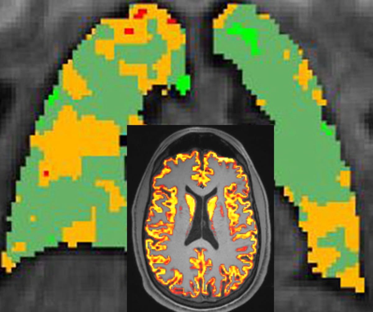 . #MRI #LongCovid Study Reveals Link Between Lower Pulmonary Gas Exchange and Cognitive Dysfunction
diagnosticimaging.com/view/mri-long-…
<a href="/ACRRFS/">ACR RFS - We've Moved! Follow <a href="/RadiologyACR/">American College of Radiology</a>.</a> <a href="/ACRYPS/">ACR YPS- We've Moved! Follow @RadiologyACR.</a> @RadiologyACR <a href="/ARRS_Radiology/">ARRS</a> <a href="/RSNA/">RSNA</a> <a href="/thoracicrad/">Society of Thoracic Radiology</a> <a href="/DukeRadiology/">Duke Radiology</a> <a href="/YaleRadiology/">Yale Department of Radiology & Biomedical Imaging</a> <a href="/MontefioreRAD/">Montefiore Radiology</a> <a href="/OSURadiology/">Ohio State Radiology</a>  
#radiology #RadRes #RSNA24