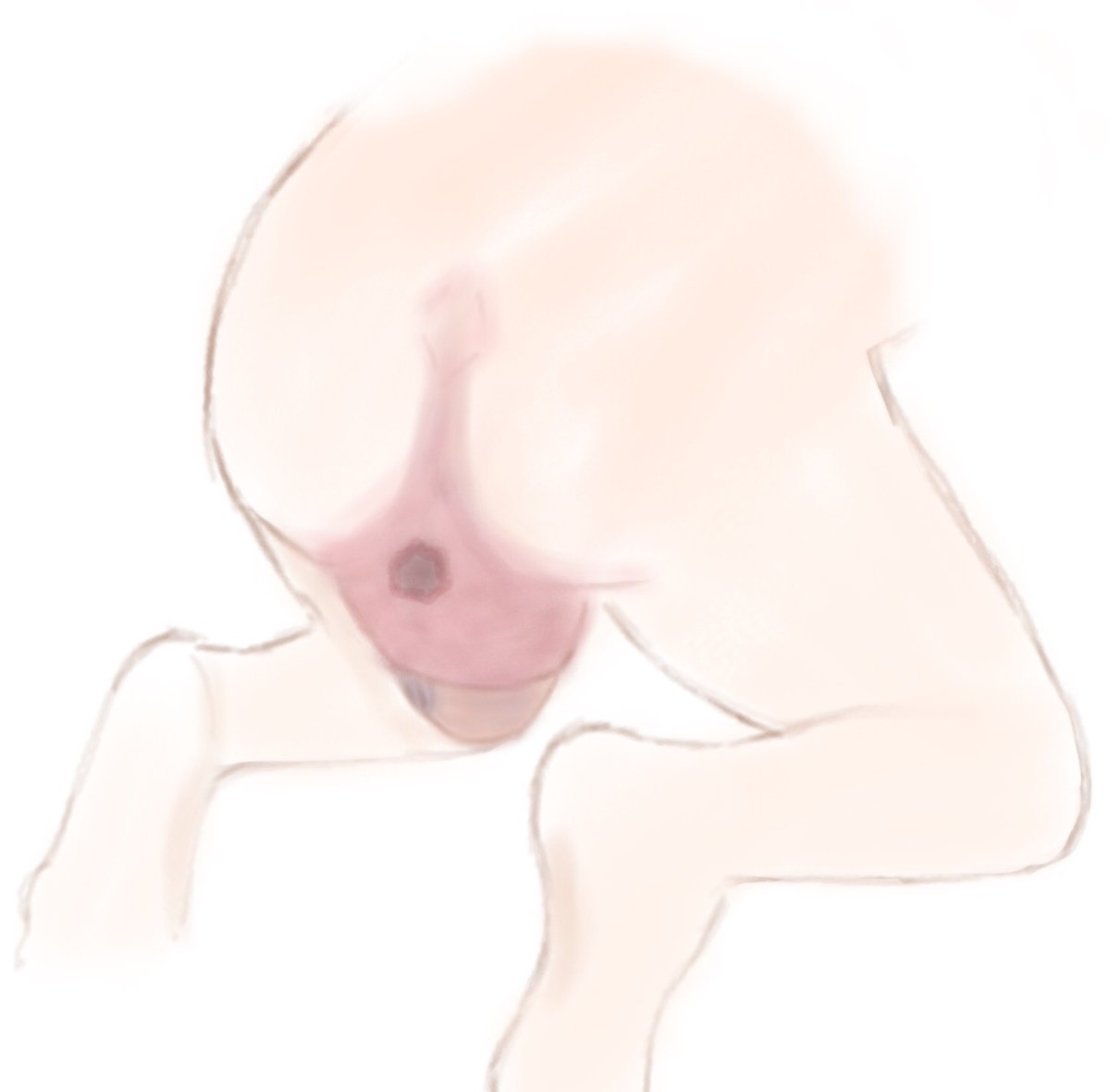 Dr Shawn Walker (@sistershawnrm) on Twitter photo Perineal outcomes and breech births: Live Webinar on Mon 9 Dec, 15.00 GMT, through your personal or institutional OptiBreech Academy subscription. Manually protect, or not? If so, how?
The role of episiotomy, and the alternatives? 
How do we counsel women about risks and options? Perineal outcomes and breech births: Live Webinar on Mon 9 Dec, 15.00 GMT, through your personal or institutional OptiBreech Academy subscription. Manually protect, or not? If so, how?
The role of episiotomy, and the alternatives? 
How do we counsel women about risks and options?