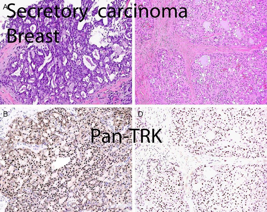 Pan-Trk immunohistochemistry (IHC) is  a sensitive assay to diagnose secretory carcinoma of the breast jcp.bmj.com/content/77/11/…