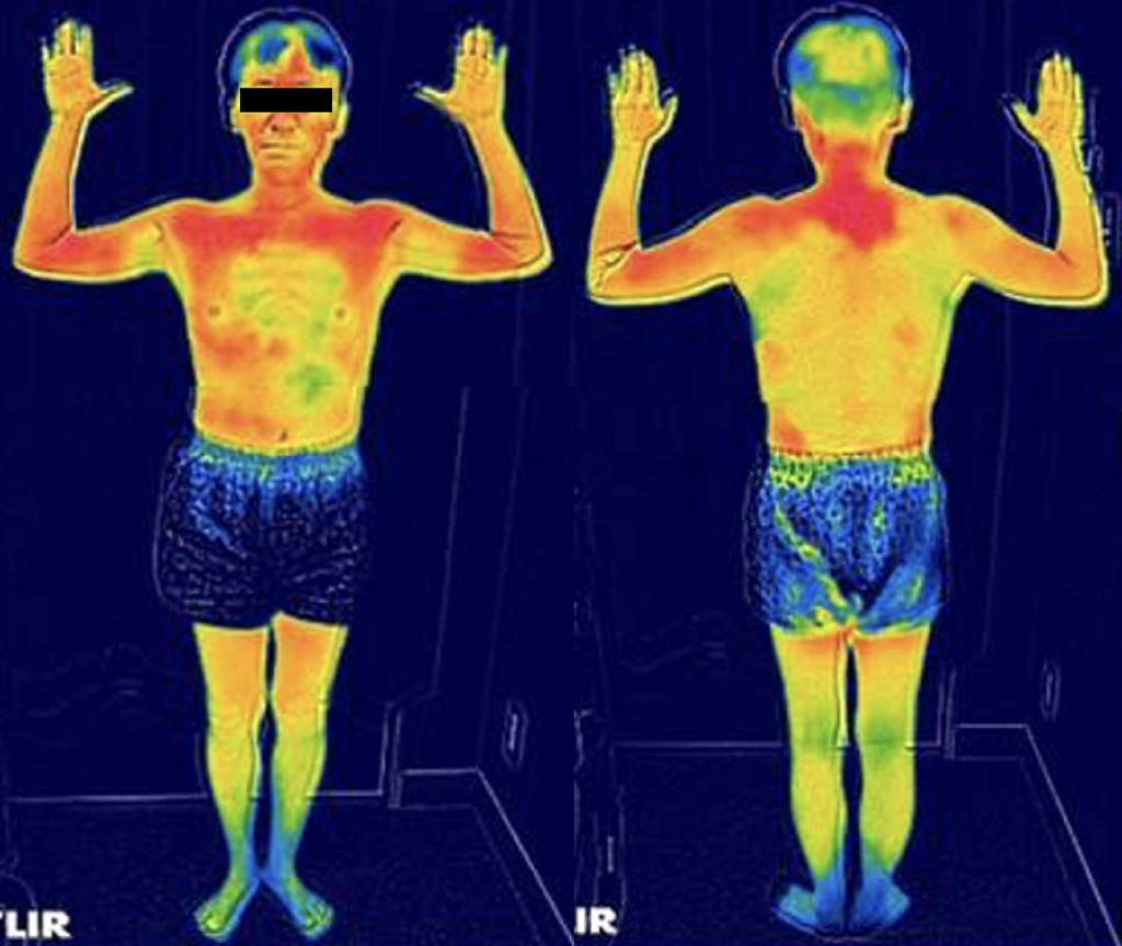Annals of Internal Medicine: Clinical Cases (@annalsofimcc) on Twitter photo Researchers from Chiba University Hospital present a case of recurrent pain and heat retention indicating the rare condition, acquired idiopathic generalized anhidrosis bit.ly/4eYUiYQ.
<a href="/1009yasutaka/">柳田育孝 Yanagita Yasutaka</a> <a href="/ACPIMPhysicians/">ACP</a> @Annalsofim <a href="/AHAScience/">AHA Science</a> #medtwitter #AHAjournals Researchers from Chiba University Hospital present a case of recurrent pain and heat retention indicating the rare condition, acquired idiopathic generalized anhidrosis bit.ly/4eYUiYQ.
<a href="/1009yasutaka/">柳田育孝 Yanagita Yasutaka</a> <a href="/ACPIMPhysicians/">ACP</a> @Annalsofim <a href="/AHAScience/">AHA Science</a> #medtwitter #AHAjournals