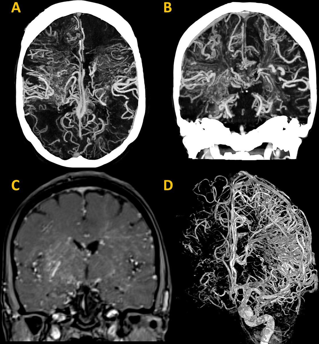 🩻Announcing the 2024 Top Images in Radiology! These standout cases showcase the power of imaging in tackling rare and complex conditions. See the link to see which articles were picked as our favorites!
pubs.rsna.org/doi/10.1148/ra…
