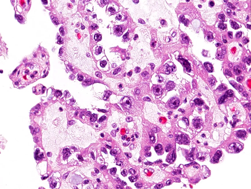 CuringN's tweet photo. Bladder &amp; urothelial tract - What's your diagnosis?

Topic link: https://t.co/liYWqzvqbK

Images contributed by Jennifer B. Gordetsky, M.D. and Aida Valencia, M.D.

#Cancer #CancerResearch #CuringCancerNetwork #Pathology https://t.co/MyLn7fd66b