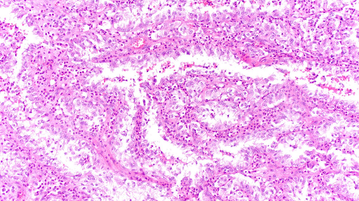 CuringN's tweet photo. Bladder &amp; urothelial tract - What's your diagnosis?

Topic link: https://t.co/liYWqzvqbK

Images contributed by Jennifer B. Gordetsky, M.D. and Aida Valencia, M.D.

#Cancer #CancerResearch #CuringCancerNetwork #Pathology https://t.co/MyLn7fd66b