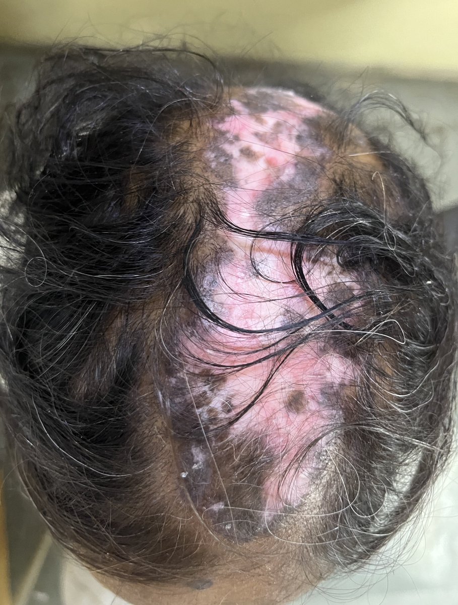 UpendraRathore_'s tweet photo. Name the Disease#Spotter# https://t.co/vHOqDHSXLm