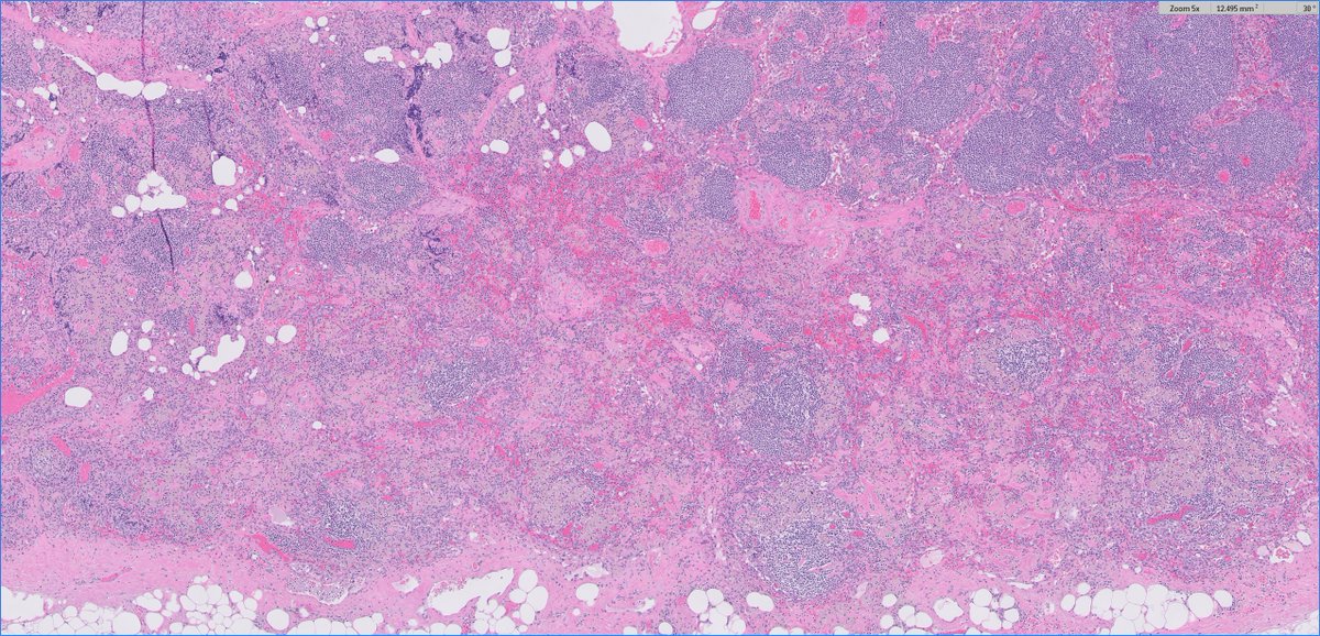 slusagar's tweet image. one my fav #beautyinb9 #GUpath+#hemepath combos:

pelvic LN dissection at time of radical prostatectomy for prostate cancer (LN slightly enlarged)

Dx: wear-debris histiocytes! (patient had prior ipsilateral knee replacement years back)
