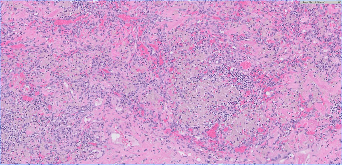 slusagar's tweet image. one my fav #beautyinb9 #GUpath+#hemepath combos:

pelvic LN dissection at time of radical prostatectomy for prostate cancer (LN slightly enlarged)

Dx: wear-debris histiocytes! (patient had prior ipsilateral knee replacement years back)