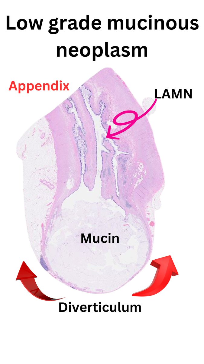 Have you ever wondered how a low-grade mucinous neoplasm enters the peritoneal cavity? Here's one way!