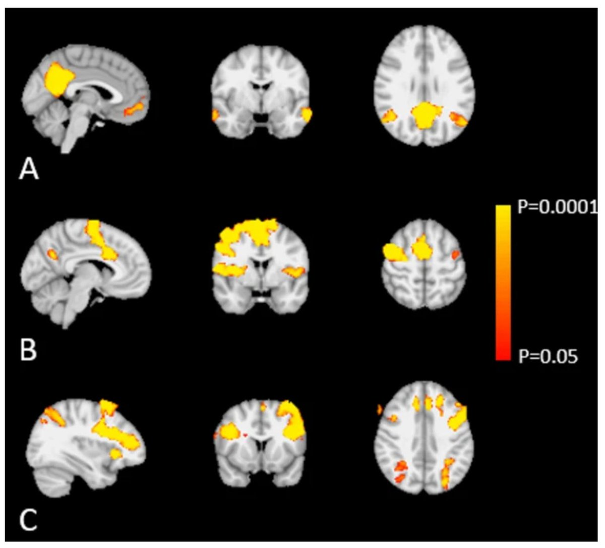 GeroScienceAGE's tweet photo. 📢New Open🔓 Access Paper Alert
Functional and vascular neuroimaging in maritime pilots with long-term sleep disruption by Lara J. Mentink (@LaraMentink) & Koen V. Haak et al.
https://t.co/VXTNf7w6O3
#sleepdisruption #neuroimaging #maritimepilots #shiftworkers #functionalmri
#vasculardamage