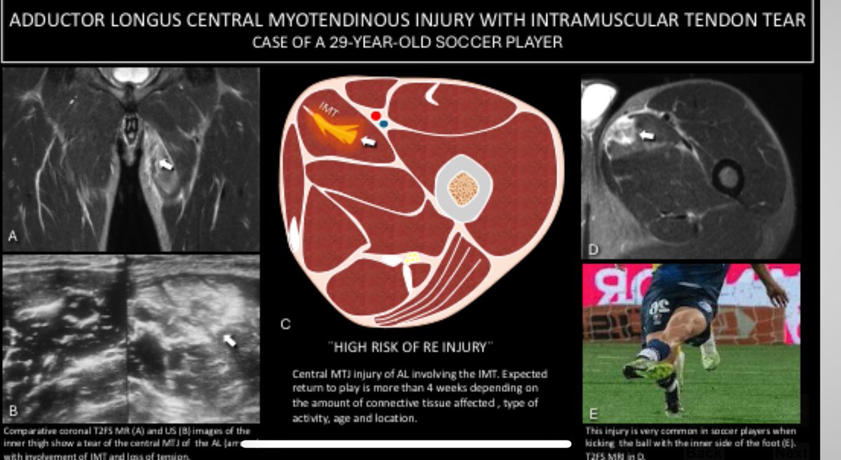 Jaime Isern Kebschull (@isernkebschull) on Twitter photo Congratulations to Dr. Agustín Marrero <a href="/AgustnMarrero/">Marrero Agustín </a> for receiving the Magna Cum Laude award for his educational exhibit at #RSNA2024 on adductor muscle complex sport injuries. What an incredible way to bring out the best of such a complex topic with so much detail and clarity! Congratulations to Dr. Agustín Marrero <a href="/AgustnMarrero/">Marrero Agustín </a> for receiving the Magna Cum Laude award for his educational exhibit at #RSNA2024 on adductor muscle complex sport injuries. What an incredible way to bring out the best of such a complex topic with so much detail and clarity!