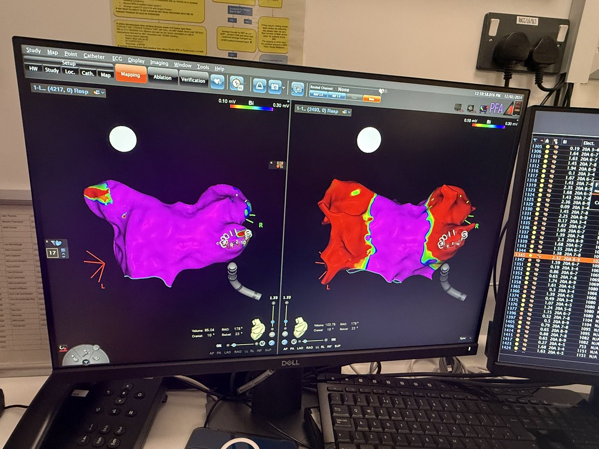 DrAshNisbet (@drashnisbet) on Twitter photo Christmas came early to us at Bristol Heart Institute as we launched Pulsed Field Ablation for our #AF patients using <a href="/jjmt_ep/">Johnson & Johnson MedTech | Electrophysiology</a>  #Varipulse! Successful first cases supported as always by our fantastic team and industry partners! #CARTO #PFA <a href="/BHIBristol/">Bristol Heart Institute</a> <a href="/PalashBarman/">Palash Barman</a> <a href="/uhbwNHS/">University Hospitals Bristol and Weston NHS FT</a> Christmas came early to us at Bristol Heart Institute as we launched Pulsed Field Ablation for our #AF patients using <a href="/jjmt_ep/">Johnson & Johnson MedTech | Electrophysiology</a>  #Varipulse! Successful first cases supported as always by our fantastic team and industry partners! #CARTO #PFA <a href="/BHIBristol/">Bristol Heart Institute</a> <a href="/PalashBarman/">Palash Barman</a> <a href="/uhbwNHS/">University Hospitals Bristol and Weston NHS FT</a>