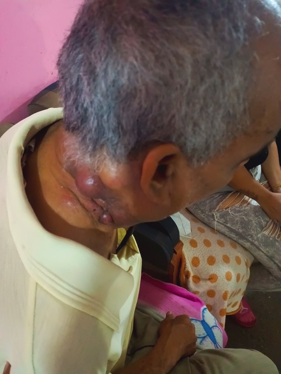 LuisReyes_30's tweet image. #URGENTE. El Sr José tiene 62 años, padece de cáncer, aunque no sabe nada. Requiere ayuda para hacerse varios estudios, entre ellos un TAC de cabeza y cuello (250$).
Con 1$ podemos acercarnos a la meta.
Él dice q le cuesta dormir por el dolor 🥹. Difundir ⚠️
#Ayuda
#CasoSocial