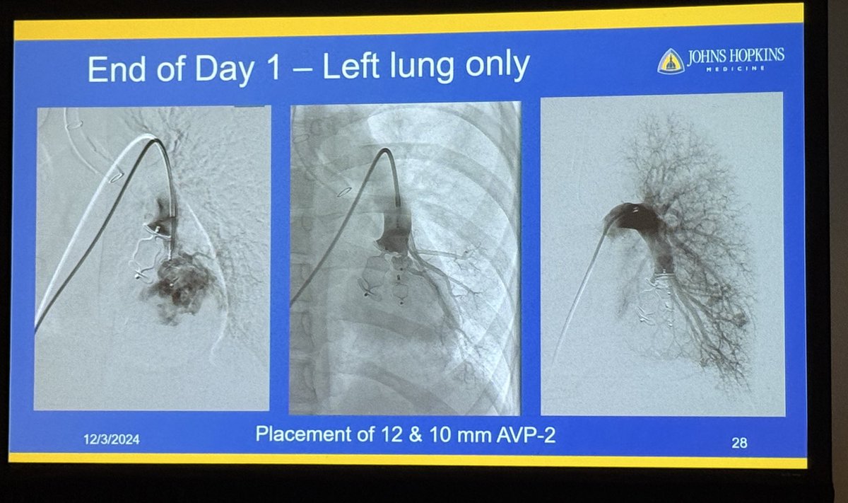 h_arezou's tweet photo. Interventional radiologists are more than proceduralists—they are clinicians who provide EXCEPTIONAL care to their patients. A great example of this was shared by @DrCliffWeiss @Hopkins_Rad , highlighting how IRs effectively manage Pulmonary AVMs. #RSNA24 @JohnsHopkinsIR @RSNA https://t.co/h5ep3H0Mj4