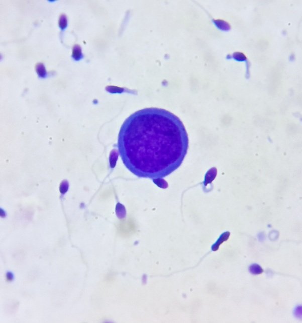 Lisa Andrology Lab Petr贸polis, RJ, Brazil馃嚙馃嚪 (@lisaandrollab) on Twitter photo <a href="/Lisaandrollab/">Lisa Andrology Lab Petr贸polis, RJ, Brazil馃嚙馃嚪</a> image from Advanced Semen Analysis. A rare image of a spermatogonium. <a href="/Lisaandrollab/">Lisa Andrology Lab Petr贸polis, RJ, Brazil馃嚙馃嚪</a> image from Advanced Semen Analysis. A rare image of a spermatogonium.