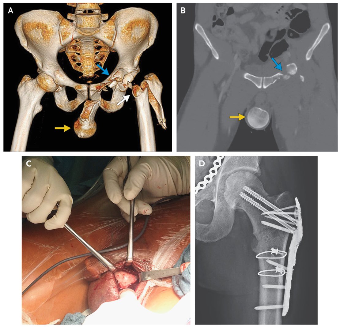 Today, while speaking to some aspiring #orthotwitter surgeons, I was asked if there’s ever a time we collaborate with general #surgery or urology

Now, I could have talked about spine or pelvis but instead I present…

“Femoral-Head Dislocation to the Scrotum”

#Medtwitter