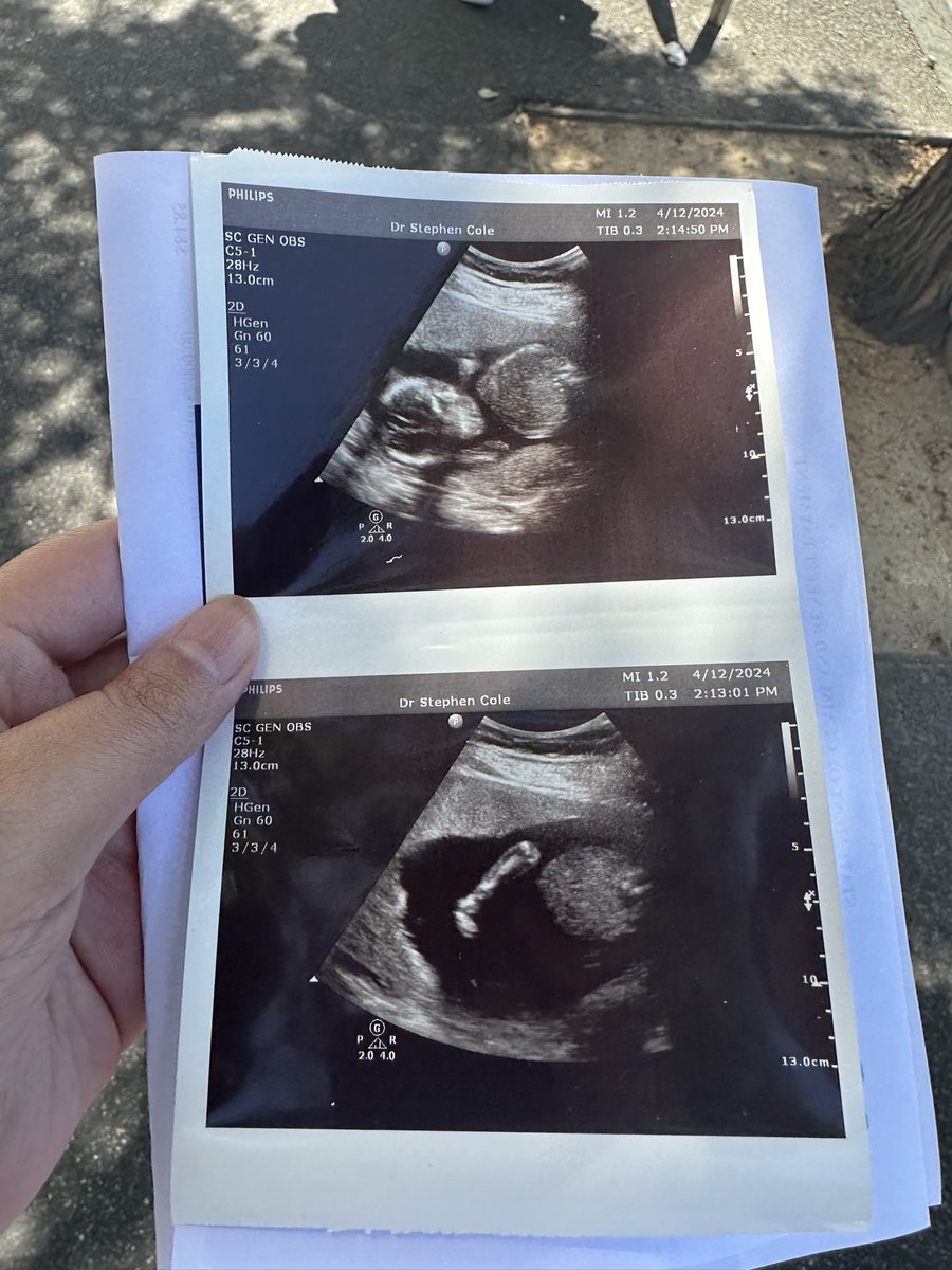 Baby is 17 weeks and 6 days old today. Heart still beating strong. I have an anterior placenta which is why I can’t feel him kick. My heart! ❤️