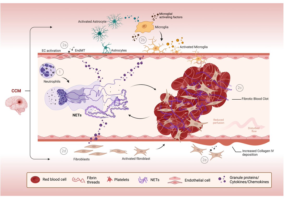 Faayvour's tweet image. I&apos;m pleased to announce that our #NCVR publication has now been released. @MagnussonLab  we present the roles of #NETs in the progression of cerebral cavernous malformations (CCM)  

Read at: doi.org/10.1038/s44161… 
#NETosis #CureCCM #TreatCCM #rarediseases