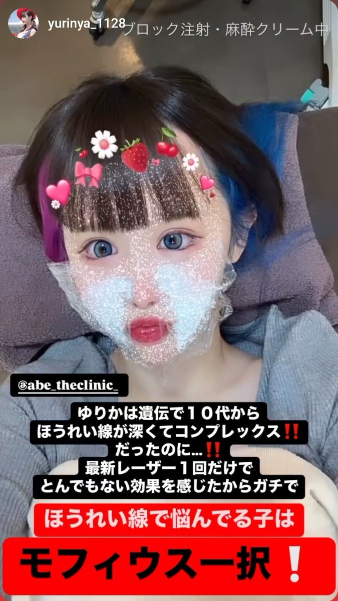 theclinic_abe's tweet photo. ほうれい線にお悩みの方はモフィウスをおすすめします。
モフィウスはほうれい線の皮膚��脂肪を両方とも引き締めます！
自分に厳しいゆりにゃさんだからこそ分かる変化。
案件でもないのに大プッシュありがとうございます✨️ https://t.co/OFVm9N3Y2p