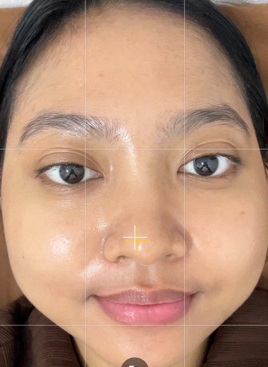 cathizza's tweet photo. UPDATE…. dermies

my skin is skinning🙌🏻

Day 1                       vs                      Day 10 https://t.co/b06WmJwpSz