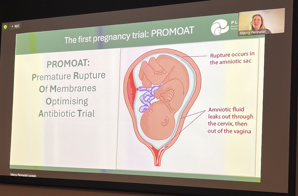 Brett J. Manley 🤷🏼♂️ (@drbretty) on Twitter photo Last up at Neonatal Twilights <a href="/MercyPerinatal/">MercyPerinatal</a> we have an obstetrician! 😡 The amazing <a href="/whitehead_cl/">Clare Whitehead</a> on the <a href="/PerinatalAPT/">The PLATIPUS trial</a> to improve preterm birth outcomes and it’s first pregnancy “domain” (trial) - the PROMOAT trial of different AB regimens for PPROM #neotwitter Last up at Neonatal Twilights <a href="/MercyPerinatal/">MercyPerinatal</a> we have an obstetrician! 😡 The amazing <a href="/whitehead_cl/">Clare Whitehead</a> on the <a href="/PerinatalAPT/">The PLATIPUS trial</a> to improve preterm birth outcomes and it’s first pregnancy “domain” (trial) - the PROMOAT trial of different AB regimens for PPROM #neotwitter