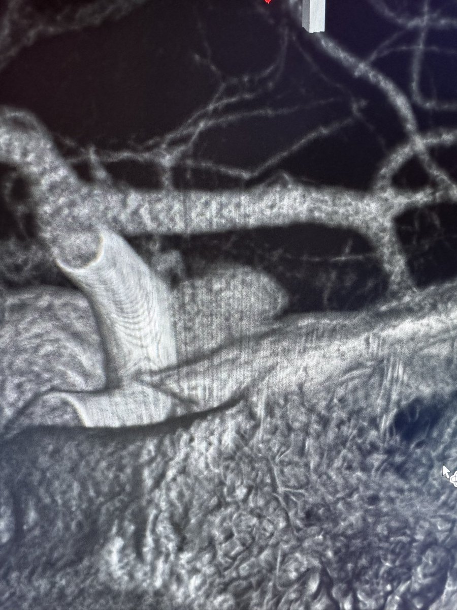 Vladimir Kalousek (@vladimirkzagreb) on Twitter photo When I grow up I want to be <a href="/eytanraz/">Eytan Raz</a> 😄.
FD case for laterally orienteted ICA aneurysm.
<a href="/neuroangio1/">Neuroangio</a> <a href="/DoctorGaldamez/">Mario Martínez-Galdámez</a> <a href="/italolinfante/">IL</a> <a href="/drpaulbhogal/">paul bhogal</a> <a href="/hldmak/">Levansri Makalanda</a> <a href="/jildazz/">Jildaz Caroff 👨🏻⚕️</a> When I grow up I want to be <a href="/eytanraz/">Eytan Raz</a> 😄.
FD case for laterally orienteted ICA aneurysm.
<a href="/neuroangio1/">Neuroangio</a> <a href="/DoctorGaldamez/">Mario Martínez-Galdámez</a> <a href="/italolinfante/">IL</a> <a href="/drpaulbhogal/">paul bhogal</a> <a href="/hldmak/">Levansri Makalanda</a> <a href="/jildazz/">Jildaz Caroff 👨🏻⚕️</a>