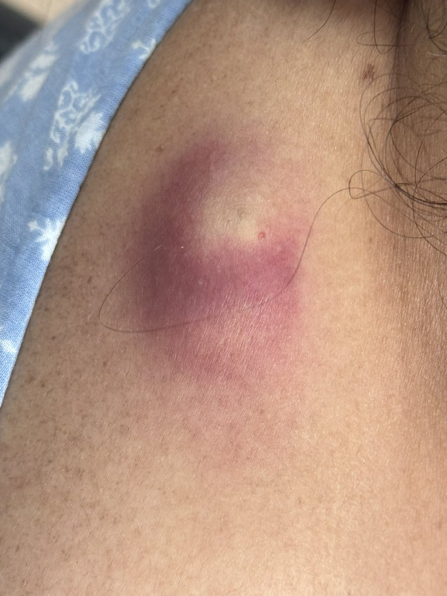 PRAVINBANODKAR's tweet photo. Infected #Sebaceous #Cyst https://t.co/7wYPXeBGLa