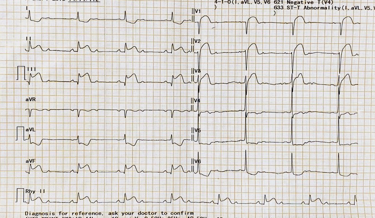 ECG for residents and fellows. Complete diagnosis? Likely infarct related artery?