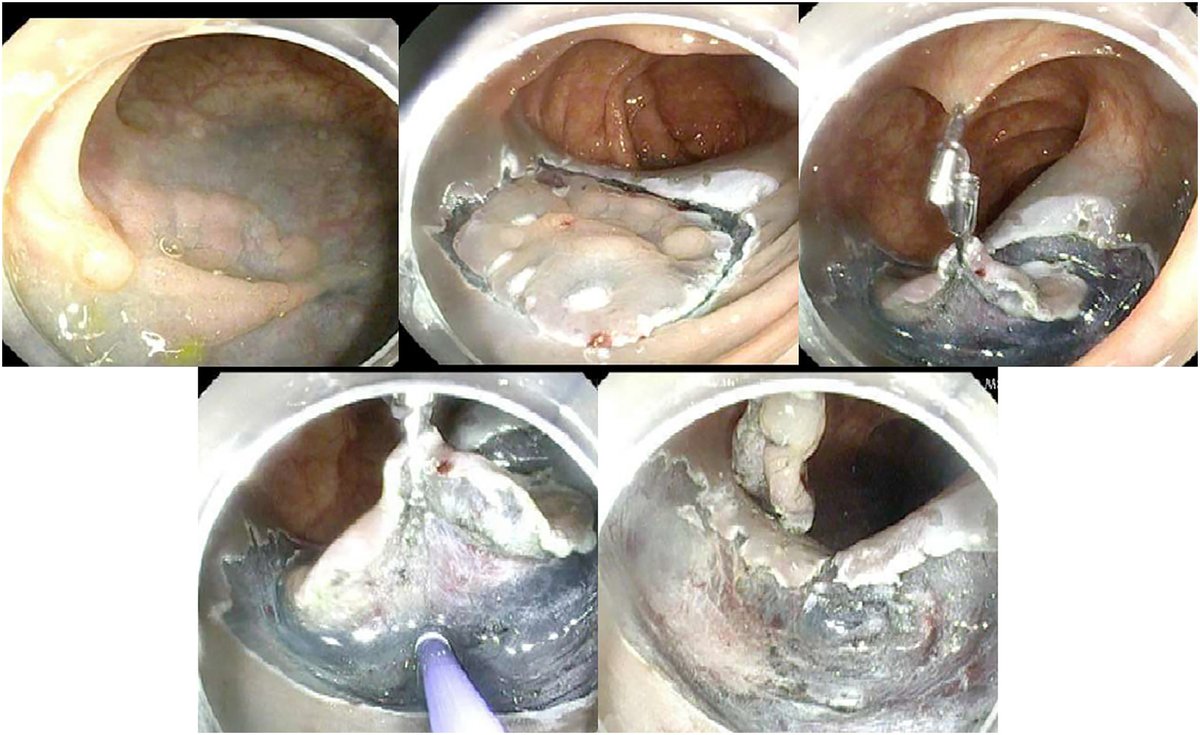TIGE (@aga_tige) on Twitter photo 🔔 Researchers discover retrospective evaluation of traction during #colon #ESD from a large North American center <a href="/EndoscopyOthman/">Mohamed Othman</a> <a href="/FaresAyoubMD/">Fares Ayoub</a> <a href="/KeihanianTara/">TaraKeihanian MD. MPH.</a> <a href="/GiJawaid/">Salmaan Jawaid, MD</a>
Read Now 🔗 ow.ly/gFoG50UkM41 🔔 Researchers discover retrospective evaluation of traction during #colon #ESD from a large North American center <a href="/EndoscopyOthman/">Mohamed Othman</a> <a href="/FaresAyoubMD/">Fares Ayoub</a> <a href="/KeihanianTara/">TaraKeihanian MD. MPH.</a> <a href="/GiJawaid/">Salmaan Jawaid, MD</a>
Read Now 🔗 ow.ly/gFoG50UkM41