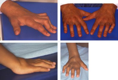 The essentials on Blau syndrome, brought to you by #GRAI (Romanian Group for #Autoinflammatory Diseases).