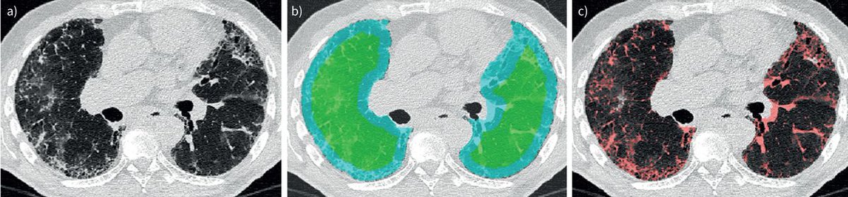ERJOR: e-Lung is an AI-powered technology that provides prognostic information from a baseline standard CT scan and, with a defined minimally clinical important difference, is more sensitive to serial change than conventional tools in the assessment of IPF bit.ly/3VEuPMI