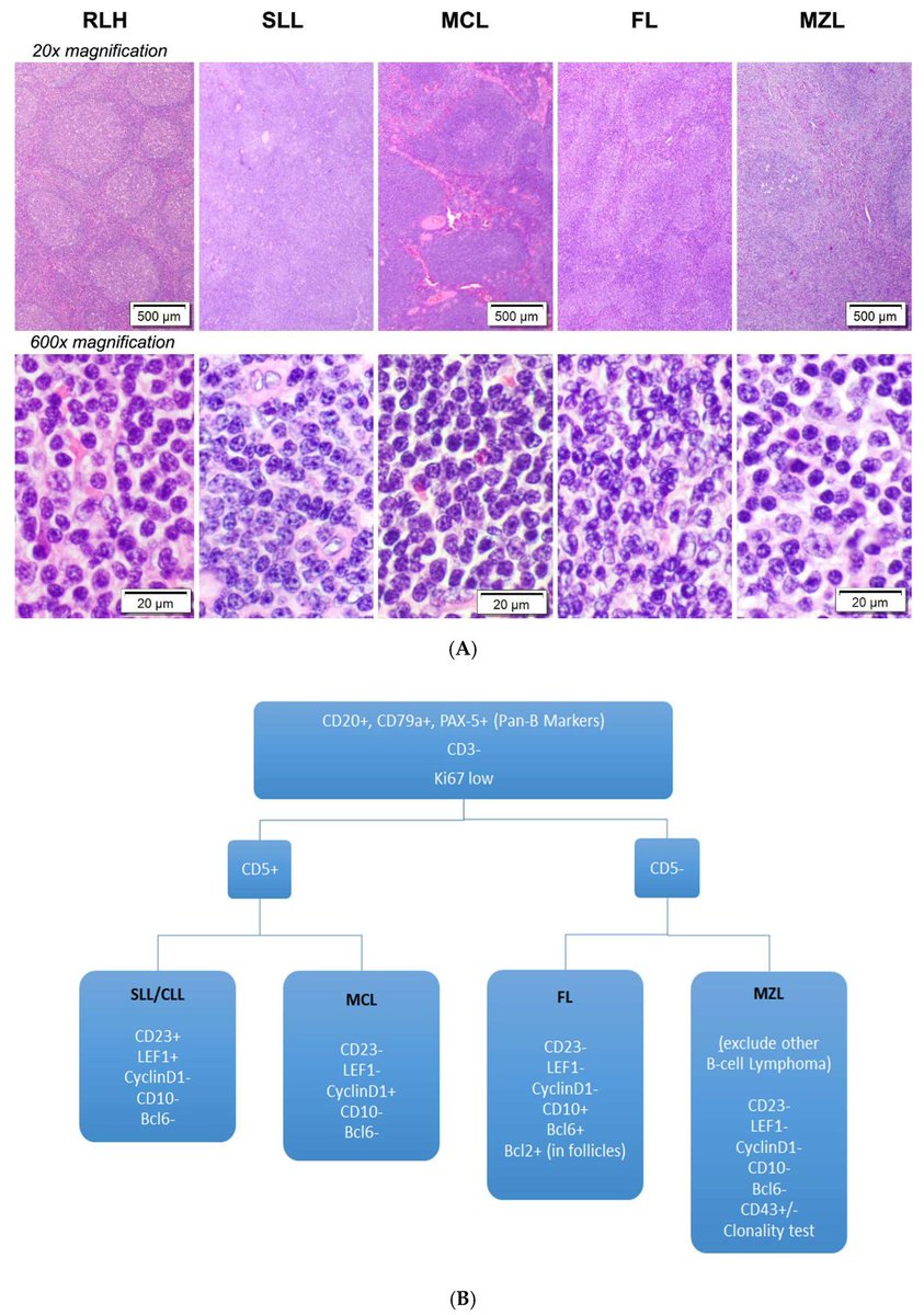 Immunohistochemistry Work Up in the Diagnosis and Subtyping of Small B-Cell Lymphomas 🔬
mdpi.com/2072-6694/15/2…