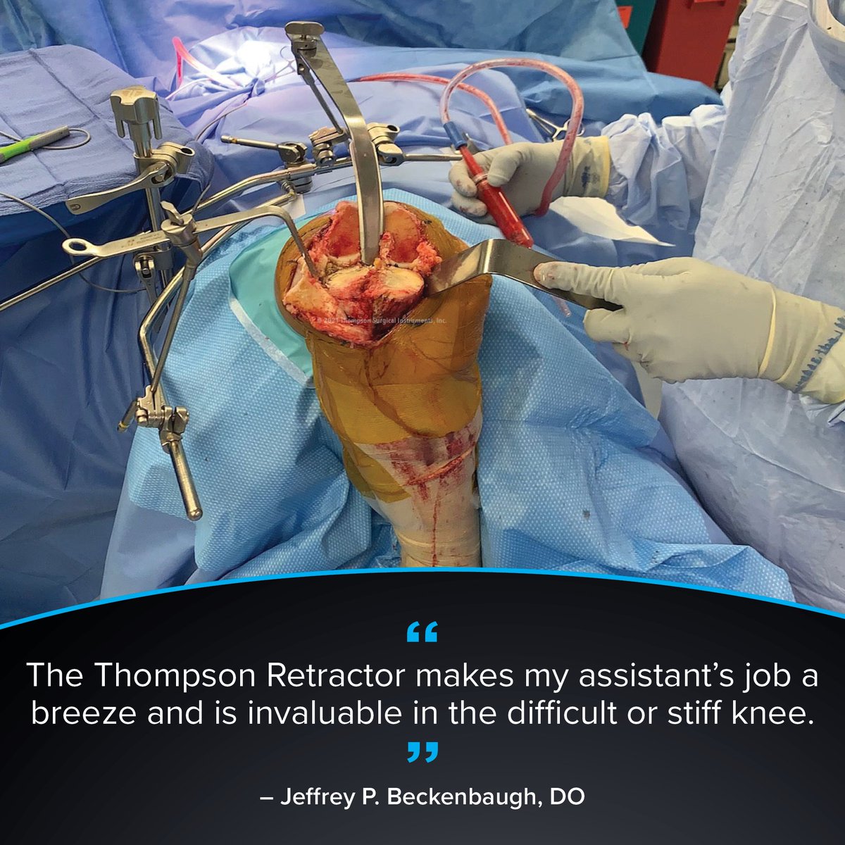 ThompsonRetract's tweet image. “The Thompson Retractor makes my assistant’s job a breeze and is invaluable in the difficult or stiff knee.” – Dr. Jeffrey P. Beckenbaugh

Trust Thompson for reliable, efficient support in complex knee procedures.

#ThompsonRetractor #KneeSurgery #SurgicalInnovation #OREfficiency