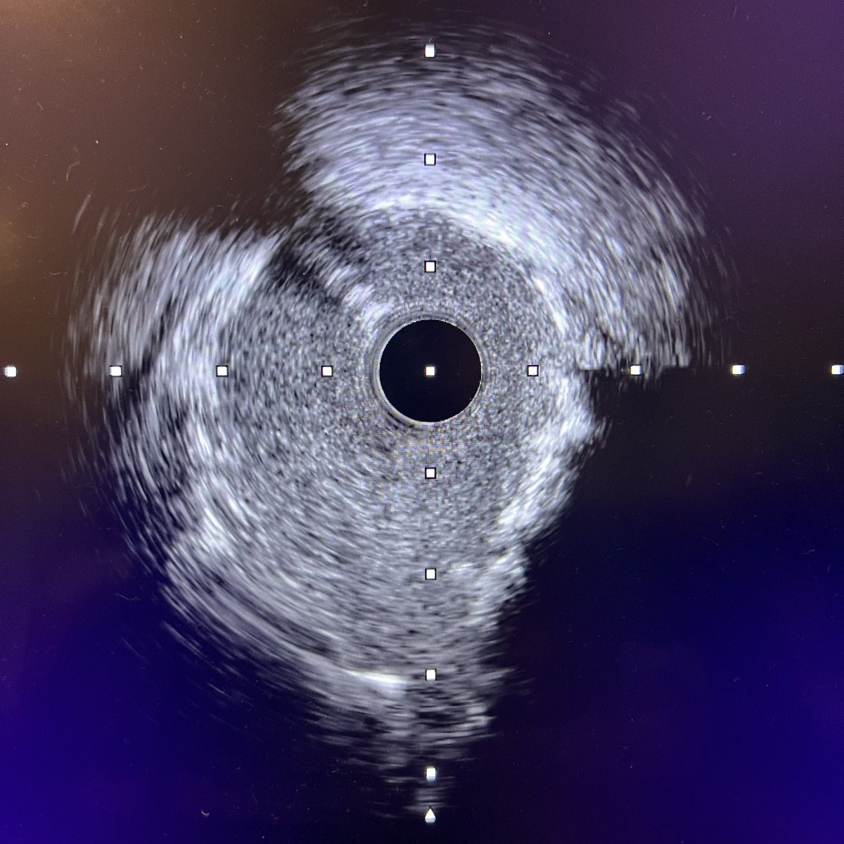 Salman Arain (@realarainmd) on Twitter photo <a href="/EuroInterventio/">EuroIntervention</a> <a href="/Laserrman/">Tsutomu Fujita MD</a> Nice! What is your approach to nodular calcium? I have settled on a ‘divide and conquer’ strategy - rota followed by IVL or aggressive cutting 🎈PTA.
Images: baseline > post rota > post CBA (18 atm) > post DES
I ❤️ to see luminal gain (MSA) as well as resolution of the lumen <a href="/EuroInterventio/">EuroIntervention</a> <a href="/Laserrman/">Tsutomu Fujita MD</a> Nice! What is your approach to nodular calcium? I have settled on a ‘divide and conquer’ strategy - rota followed by IVL or aggressive cutting 🎈PTA.
Images: baseline > post rota > post CBA (18 atm) > post DES
I ❤️ to see luminal gain (MSA) as well as resolution of the lumen