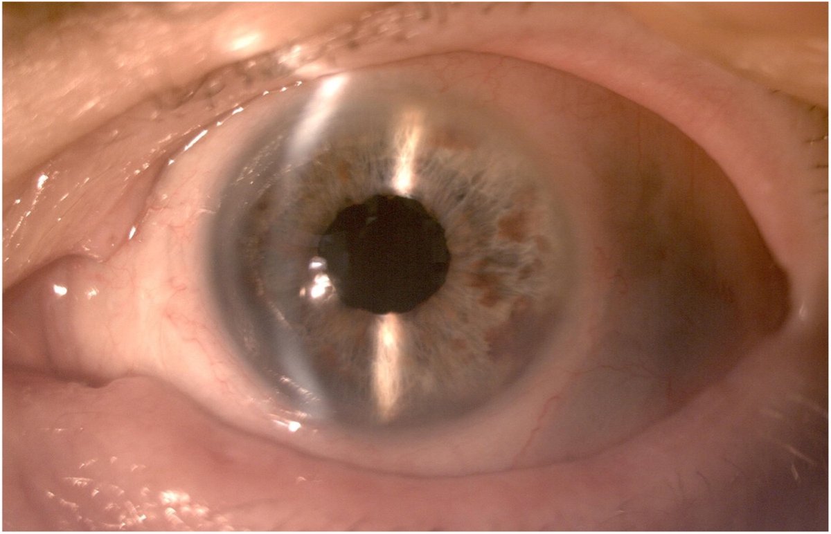 Reverse pupillary block after implantation of a sutureless scleral fixation (SFF) IOL (Carlevale, Soleko)
ow.ly/30A350TNzs8
#ophthalmology #retina