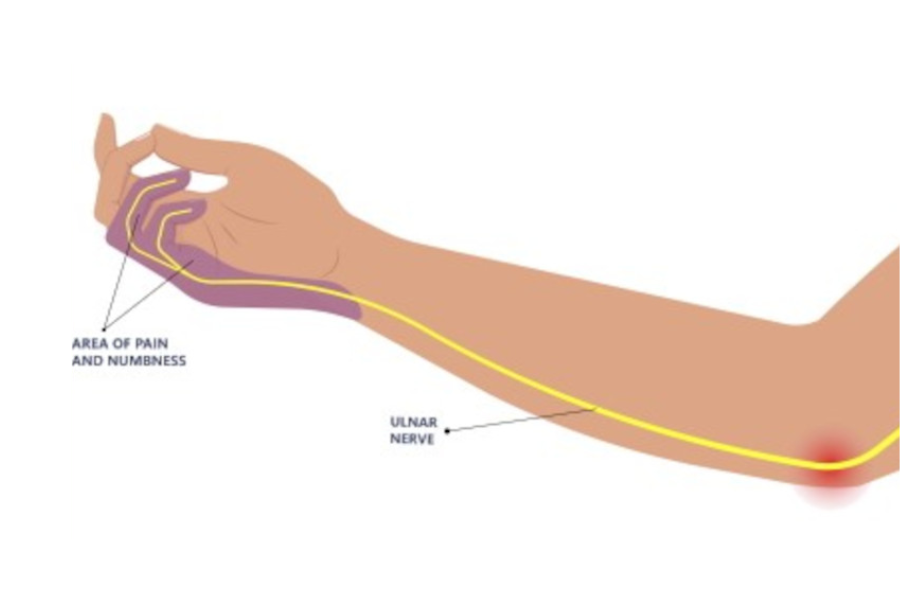 SportsMedReview's tweet photo. The scratch collapse test is used to evaluate for cubital tunnel syndrome, sensitivity ranges from 10-69% while specificity is 89-90%. Be sure to subscribe for more content!

Watch: https://t.co/K9wujthoLr

Read: https://t.co/mVSbMuHjr0

#sportsmed #sportsmedicine #medicine #sports #foamSM #MedEd #FOAMed #ortho #medtwitter #OrthoTwitter #medschool #athletictraining #physicaltherapy