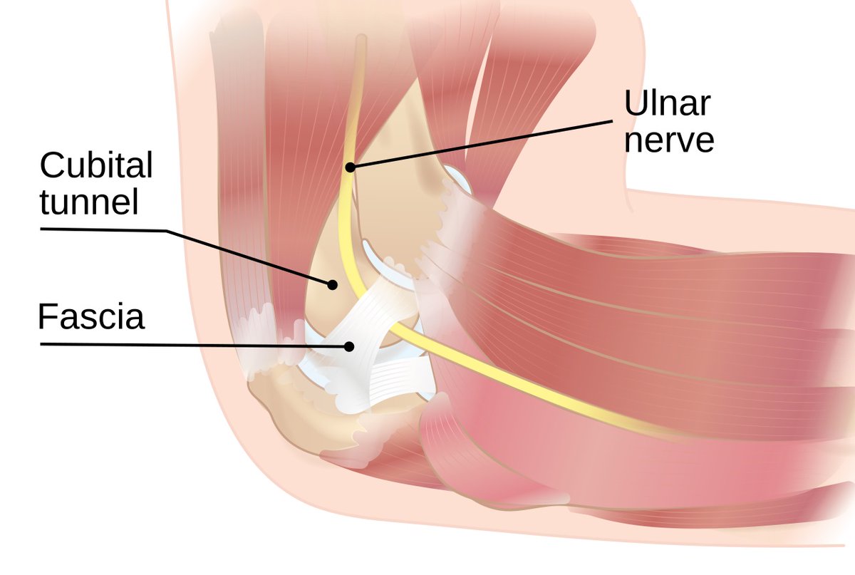 SportsMedReview's tweet photo. The scratch collapse test is used to evaluate for cubital tunnel syndrome, sensitivity ranges from 10-69% while specificity is 89-90%. Be sure to subscribe for more content!

Watch: https://t.co/K9wujthoLr

Read: https://t.co/mVSbMuHjr0

#sportsmed #sportsmedicine #medicine #sports #foamSM #MedEd #FOAMed #ortho #medtwitter #OrthoTwitter #medschool #athletictraining #physicaltherapy