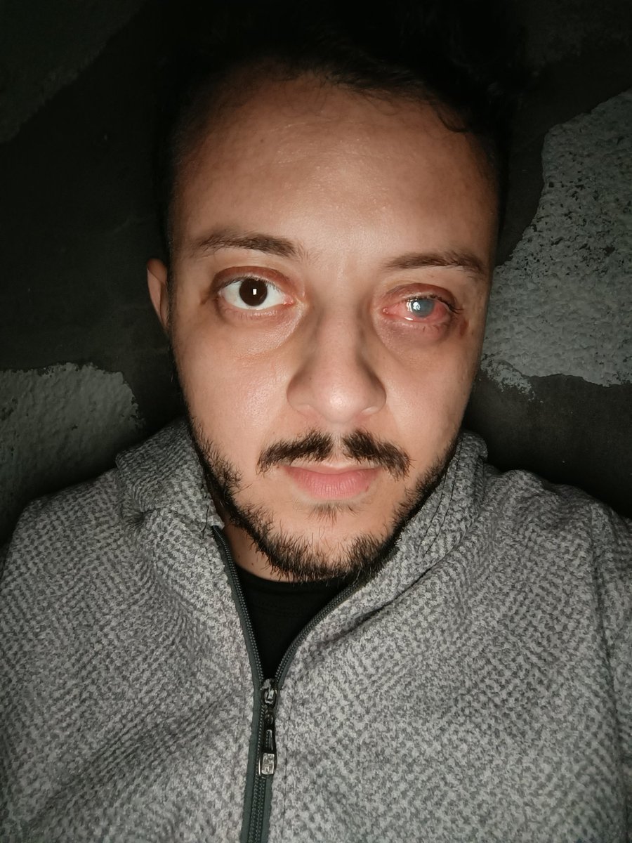 ahmedshameya995's tweet photo. Still alive, still suffering and still hurting from my eye. 
Please pray for me 
https://t.co/GJsRia72F1 https://t.co/9tOSQcjG9o