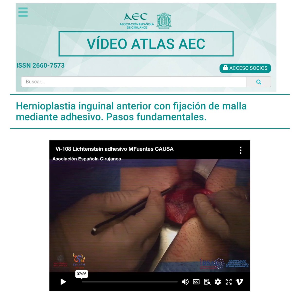 Curro Blanco (@curro_blanco) on Twitter photo Ya está disponible online el último trabajo sobre cirugía de la pared abdominal aportado por el Servicio de Cirugía General del #CAUSA al Vídeo Atlas de la <a href="/aecirujanos/">aecirujanos</a>
aecirujanos.es/Hernioplastia-…
#SomosCAUSA #SomosSACYL #seguimos #Formacion #VideoAtlas Ya está disponible online el último trabajo sobre cirugía de la pared abdominal aportado por el Servicio de Cirugía General del #CAUSA al Vídeo Atlas de la <a href="/aecirujanos/">aecirujanos</a>
aecirujanos.es/Hernioplastia-…
#SomosCAUSA #SomosSACYL #seguimos #Formacion #VideoAtlas
