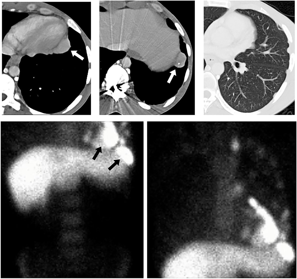Recognize the imaging features of various heterotopic and ectopic splenic conditions to prompt correct diagnosis and avoid misdiagnosis as a neoplasm or lymphadenopathy. bit.ly/3UVUgcL