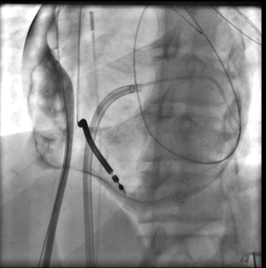 Example of  <a href="/inheartmedical/">inHEART</a> for epicardial access planning. Young patient with small thorax, not much space between LIMA and sternum. More medial needle approach used. CO2 insufflation for added safety. Fluoro shot is in LAO (didn't save AP)! Inferolateral epi VT ablated. #EPeeps