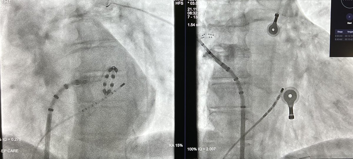 Andreas Müssigbrodt (@epwavedoc) on Twitter photo #Epeeps I’ve spent a great week w the EP team of <a href="/Phiso_de/">Philipp Sommer</a> <a href="/HdzNrw/">HDZ NRW</a>. My main mission was to see AF abl w #PFA but saw VT, PVC, Aflu, WPW, LBBAP, EV ICD too <a href="/Phiso_de/">Philipp Sommer</a> <a href="/melhamriti/">El Hamriti Mustapha</a> <a href="/MoneebKhalaph/">Moneeb Khalaph</a> <a href="/GuramImnadze/">Guram Imnadze</a> <a href="/Cardioschool/">Maxim Didenko, MD PhD</a> <a href="/VanessaSciacca_/">Vanessa Sciacca</a> et al made me feel very welcome! Merci 🙏 #Epeeps I’ve spent a great week w the EP team of <a href="/Phiso_de/">Philipp Sommer</a> <a href="/HdzNrw/">HDZ NRW</a>. My main mission was to see AF abl w #PFA but saw VT, PVC, Aflu, WPW, LBBAP, EV ICD too <a href="/Phiso_de/">Philipp Sommer</a> <a href="/melhamriti/">El Hamriti Mustapha</a> <a href="/MoneebKhalaph/">Moneeb Khalaph</a> <a href="/GuramImnadze/">Guram Imnadze</a> <a href="/Cardioschool/">Maxim Didenko, MD PhD</a> <a href="/VanessaSciacca_/">Vanessa Sciacca</a> et al made me feel very welcome! Merci 🙏