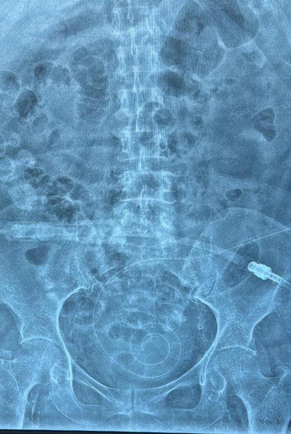 Mordmi04's tweet image. Imágenes que te dan satisfacción de solo verlo, tenckhoff percutaneo en paciente con enfermedad multivaso!! 
💪🏻💪🏻💪🏻👌🏻👌🏻👌🏻
#pdfirst #nefro #nefrointervencion