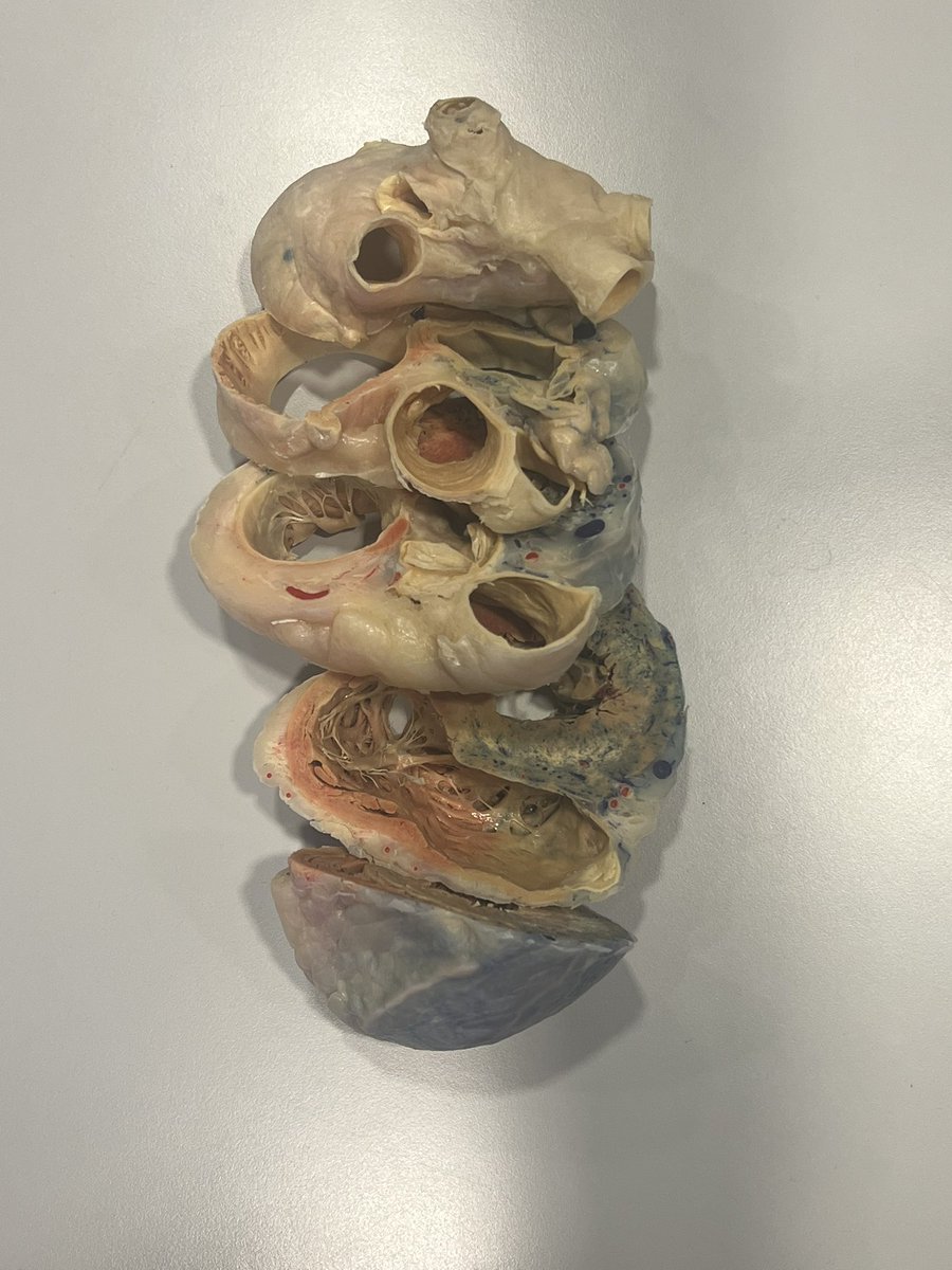 Andreas Müssigbrodt (@epwavedoc) on Twitter photo What an inspiring course I got to attend today as ‘student of anatomy’ ➡️Clinical Anatomy of the ❤️ for Successful Arrhythmia Treatment⬅️ 🌟🌟🌟🌟🌟A must-do for #Epeeps! Huge kudos to <a href="/Cardioschool/">Maxim Didenko, MD PhD</a> <a href="/GuramImnadze/">Guram Imnadze</a>, you’re amazing teachers! Thank you, @Phiso, for the invitation 🙏 What an inspiring course I got to attend today as ‘student of anatomy’ ➡️Clinical Anatomy of the ❤️ for Successful Arrhythmia Treatment⬅️ 🌟🌟🌟🌟🌟A must-do for #Epeeps! Huge kudos to <a href="/Cardioschool/">Maxim Didenko, MD PhD</a> <a href="/GuramImnadze/">Guram Imnadze</a>, you’re amazing teachers! Thank you, @Phiso, for the invitation 🙏